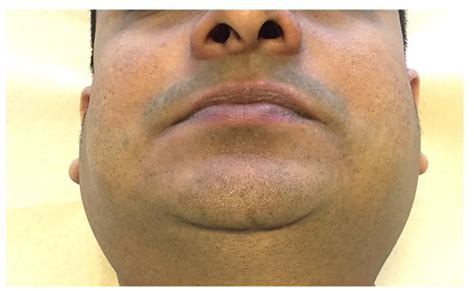 prada cleats|picture of parotid gland swelling.